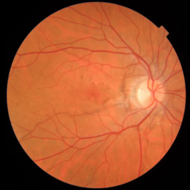 Early detection changes outcomes